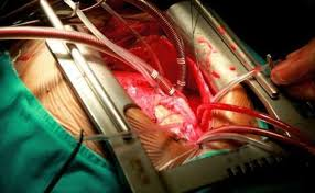 heart surgery